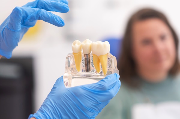 How Long Do Dental Implants Crowns Last?